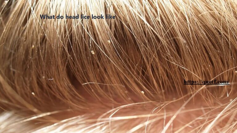 What Do Head Lice Look like?